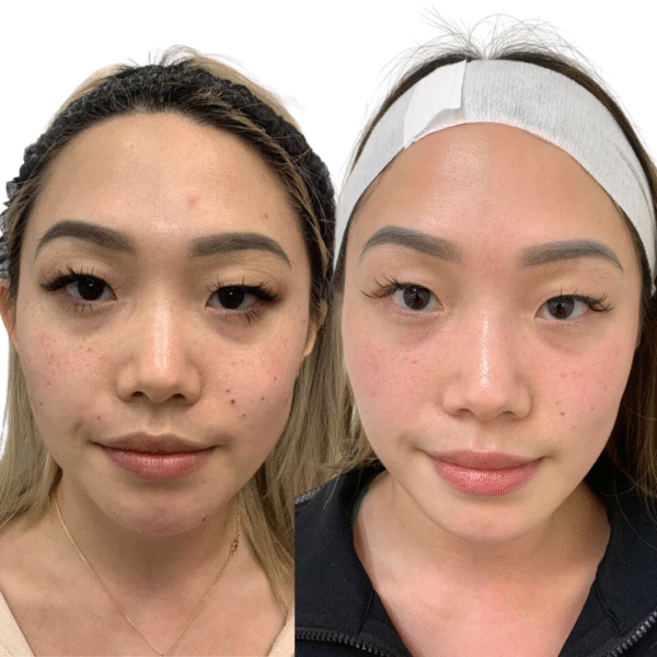 Pigmentation