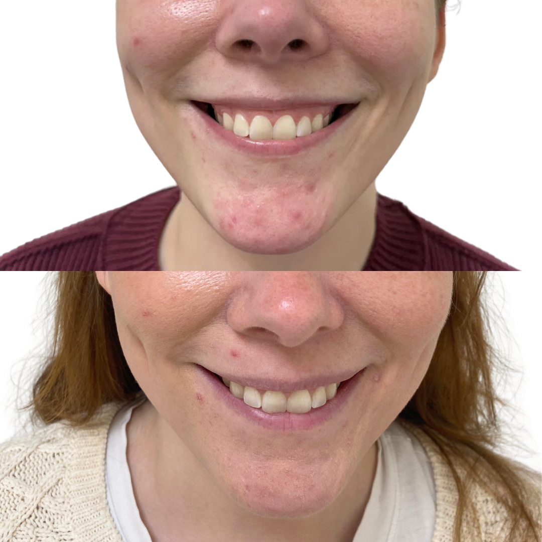 Botox Gummy Smile