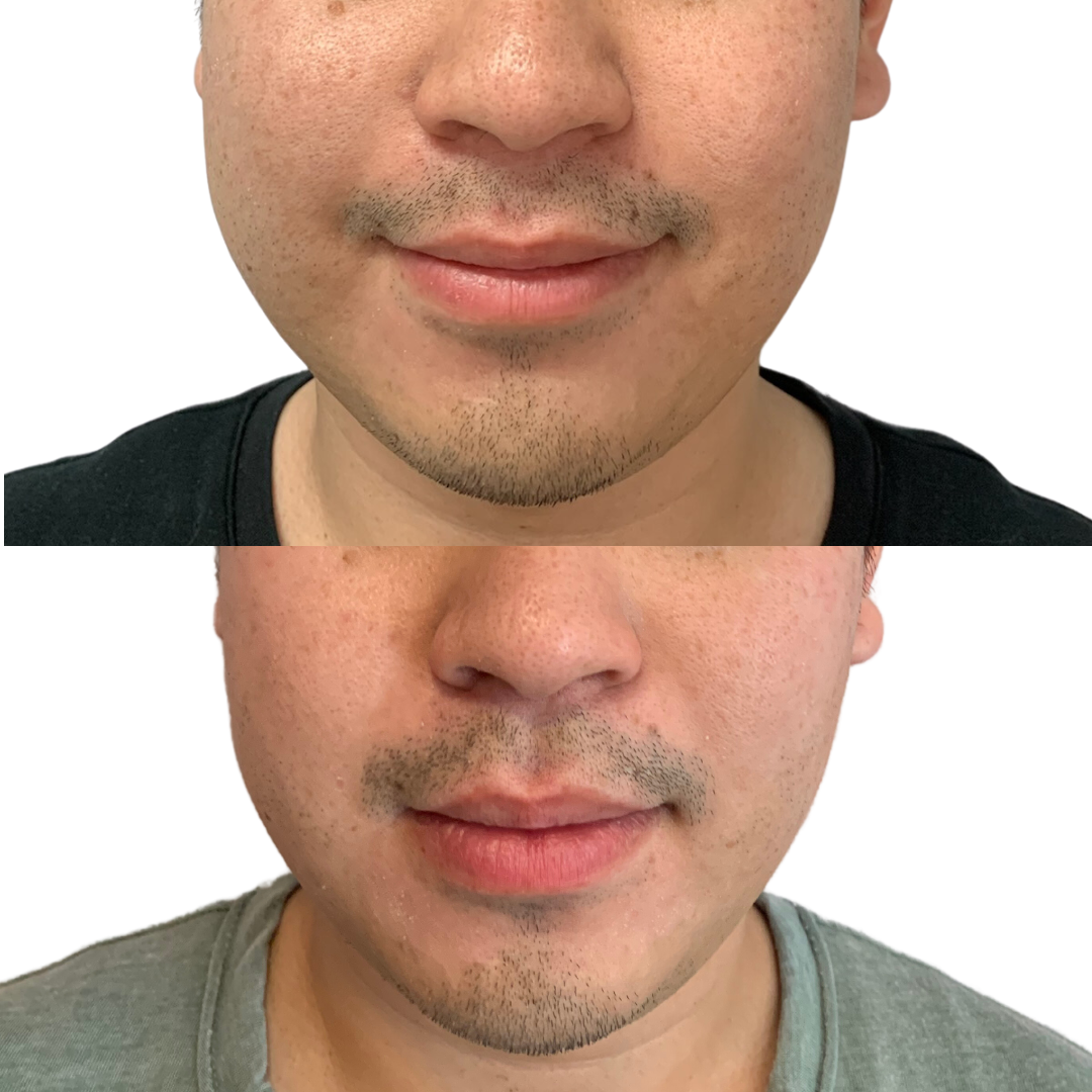 Botox for Facial