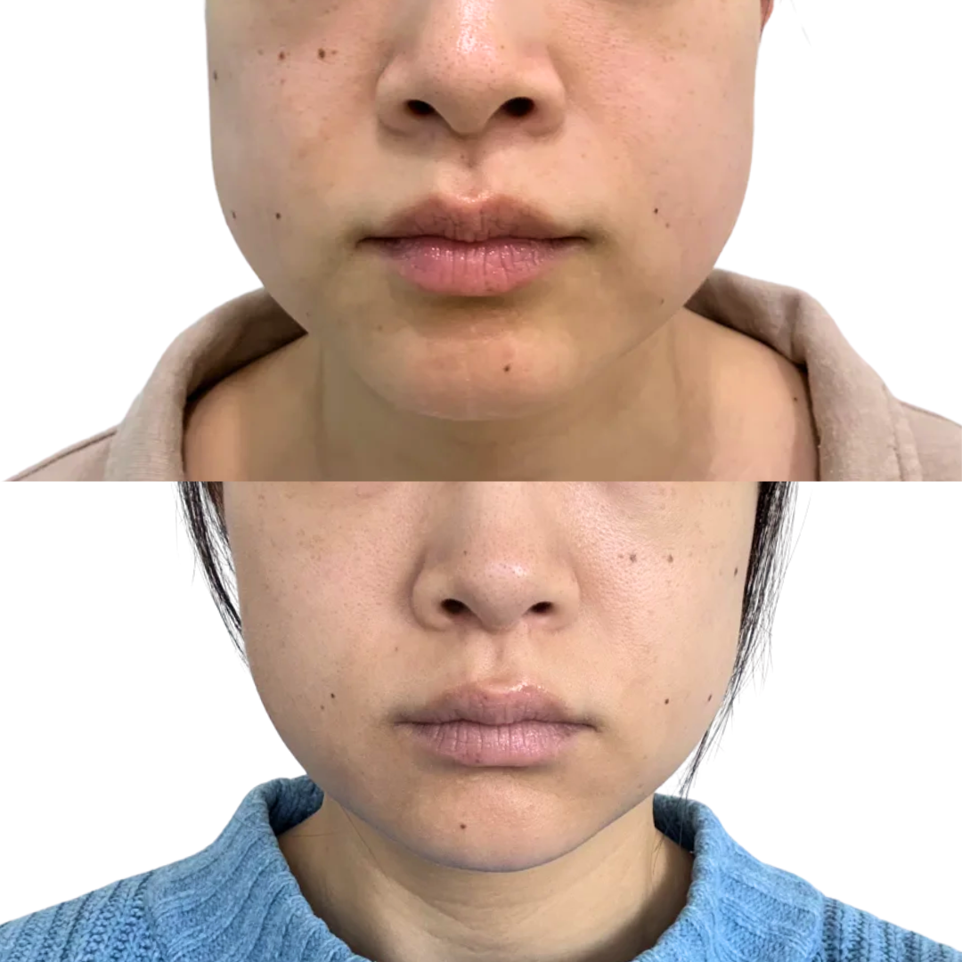 Botox for Facial