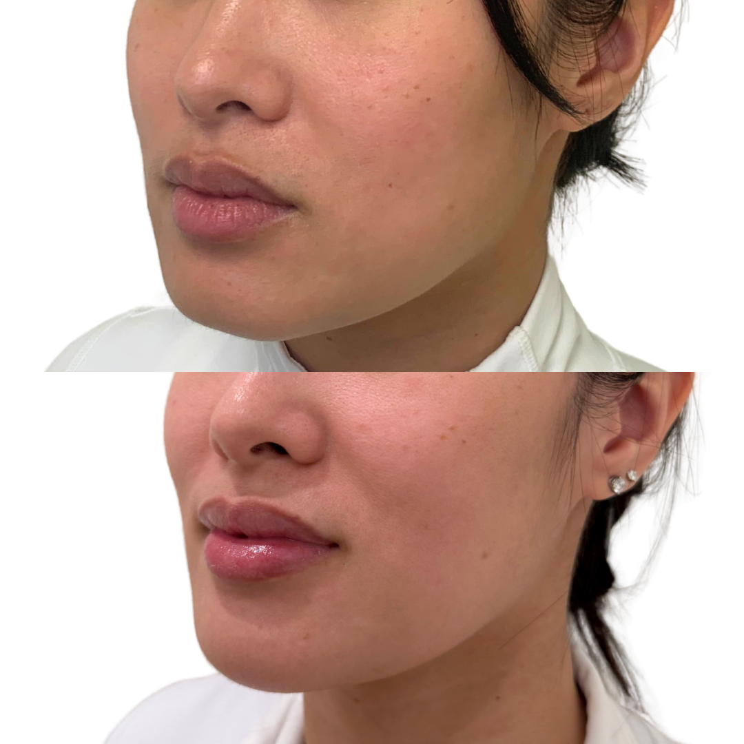 Botox for Facial