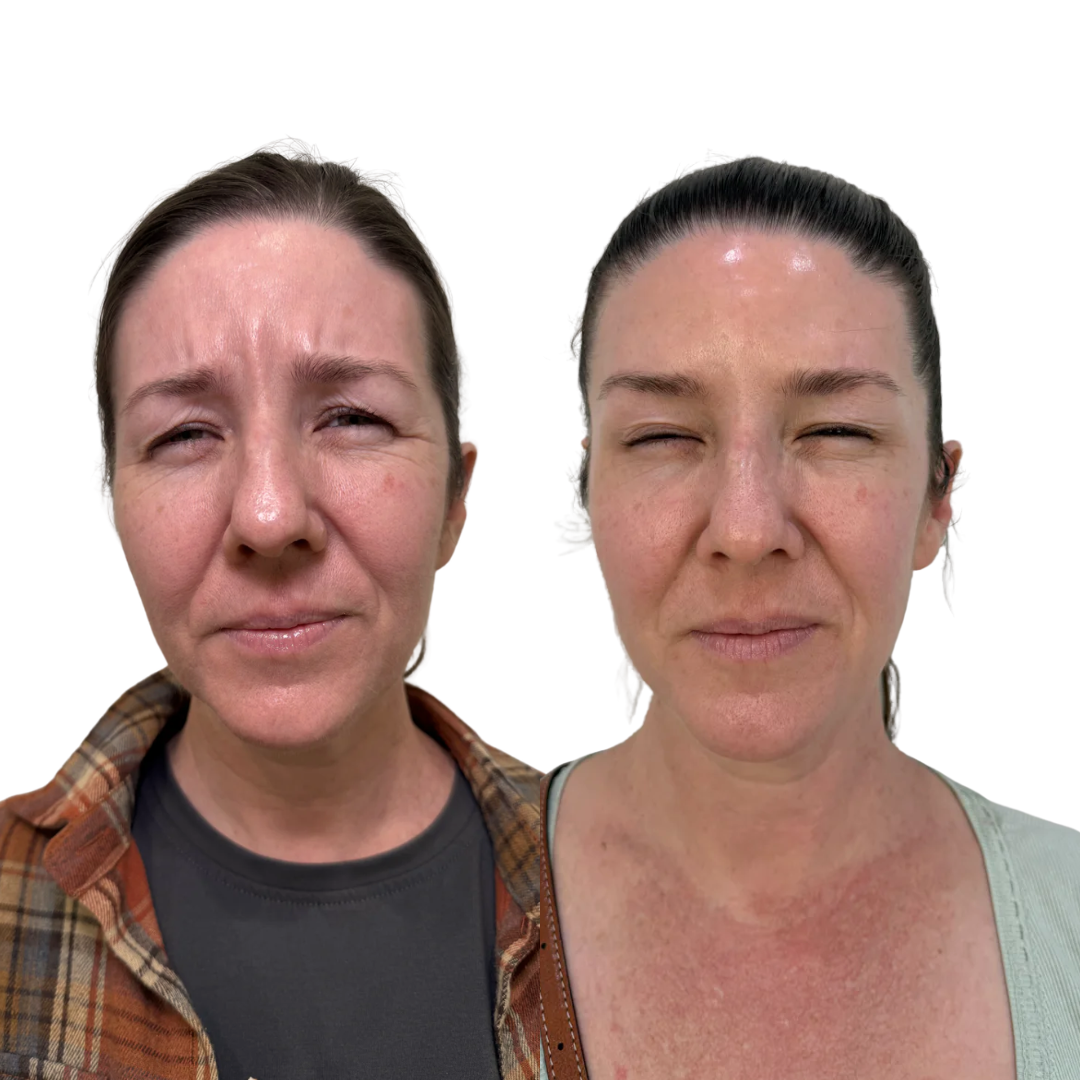 Botox to Frownlines