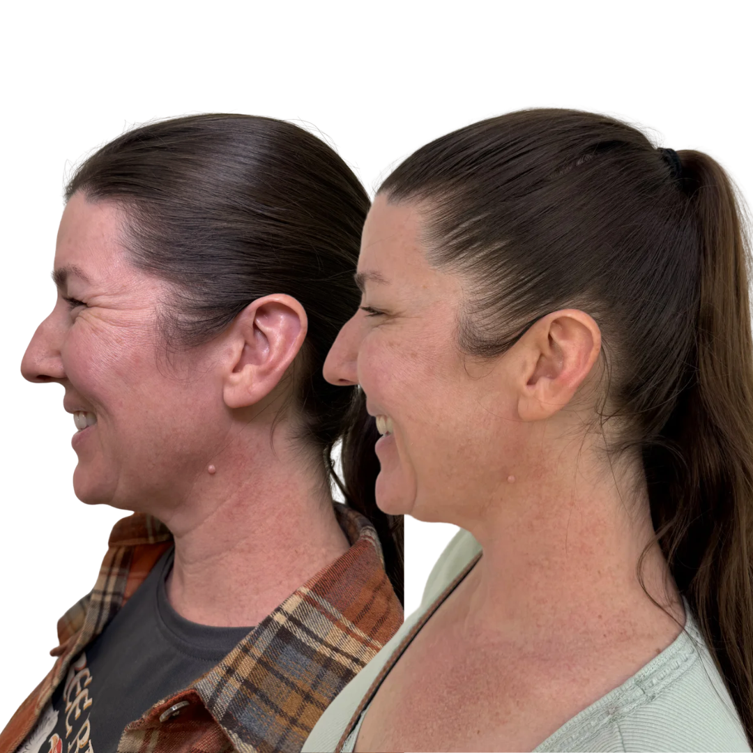 Botox to Crowsfeet