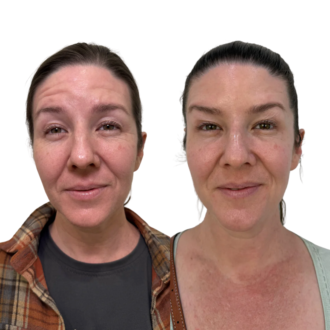Botox to forehead