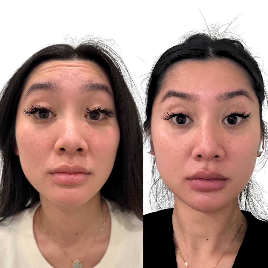 Botox to Frontalis Forehead