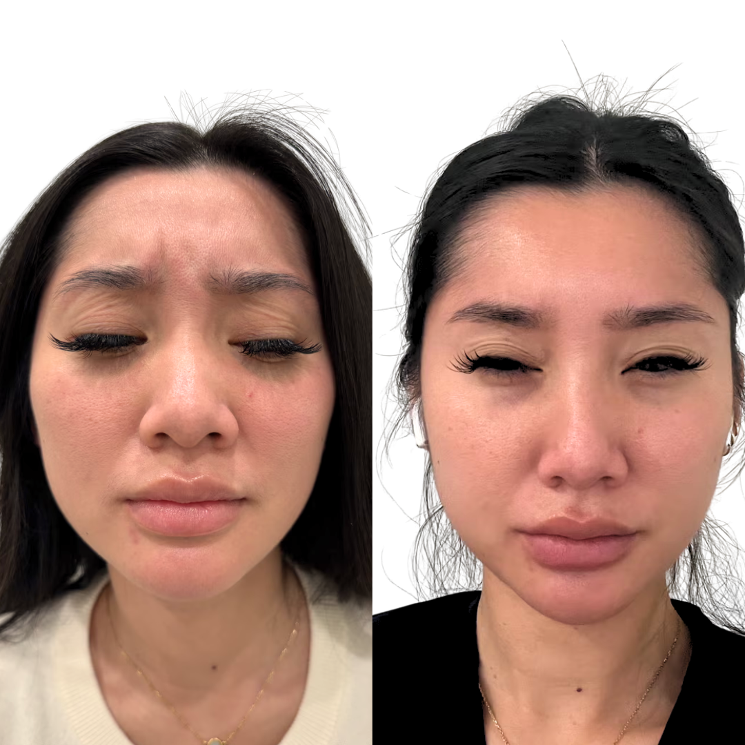 Botox to Frownlines