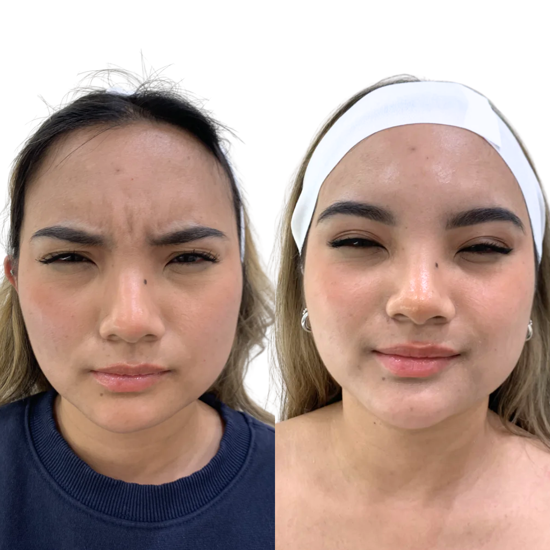 Botox to Frownlines