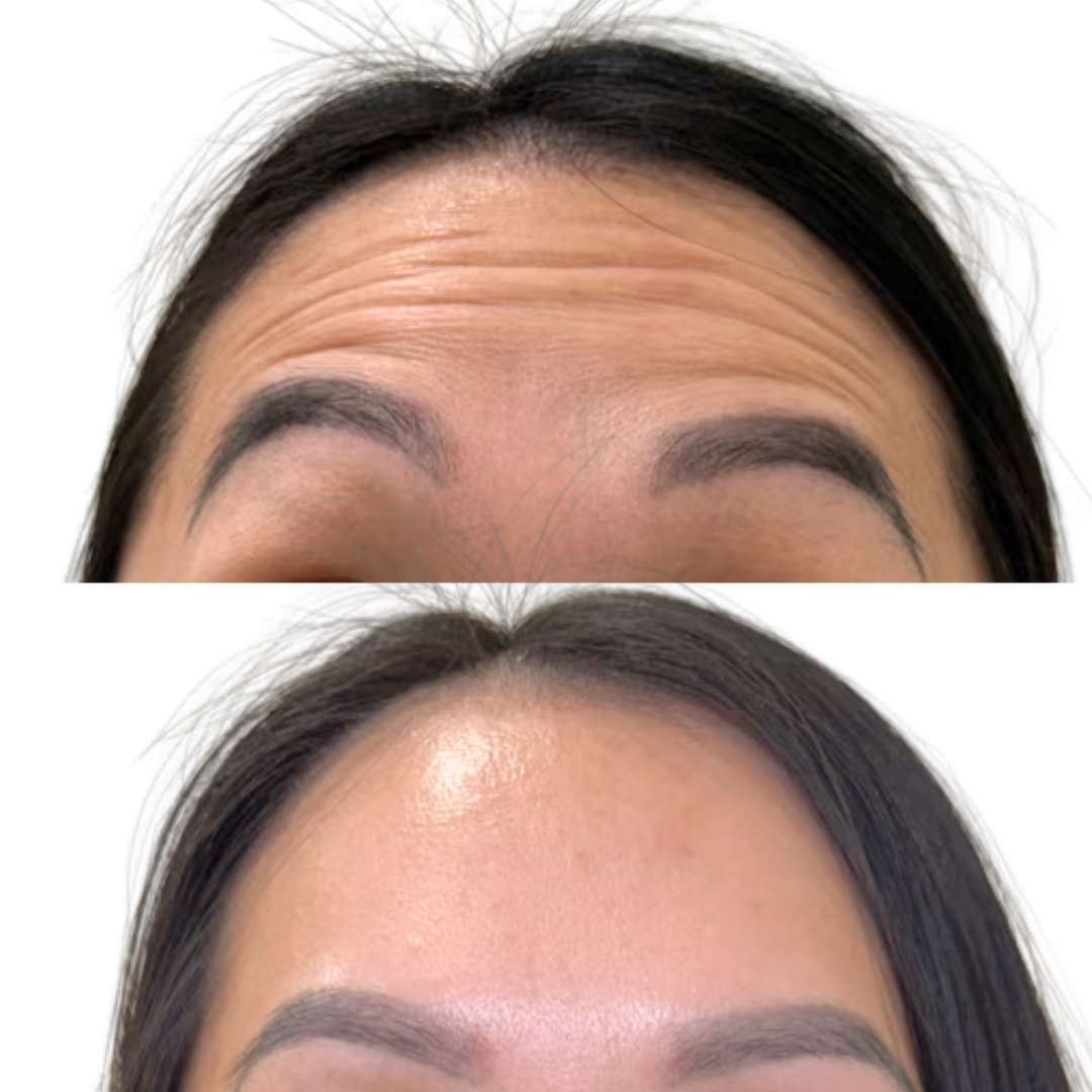 Forehead Botox