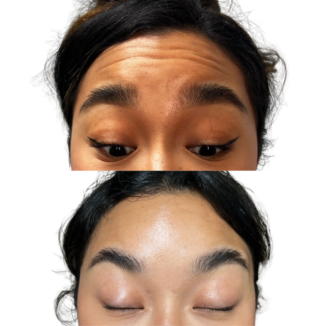 Forehead Botox