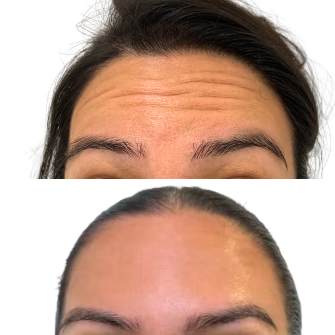 Forehead Botox