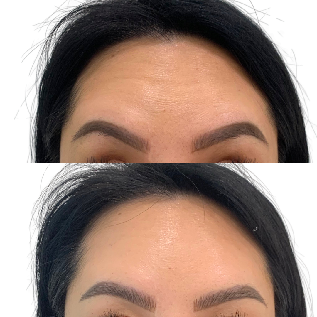 Forehead Botox