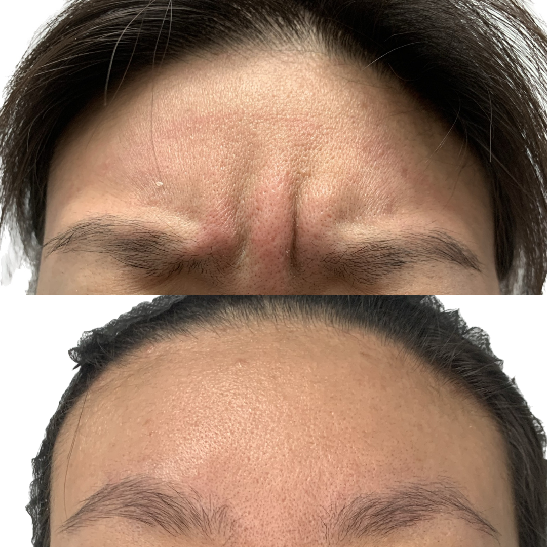 Frownlines Botox