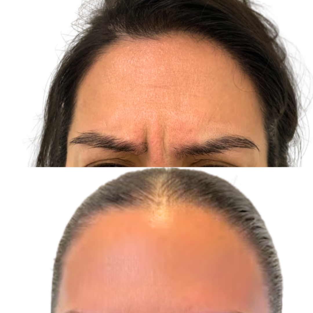Frownlines Botox