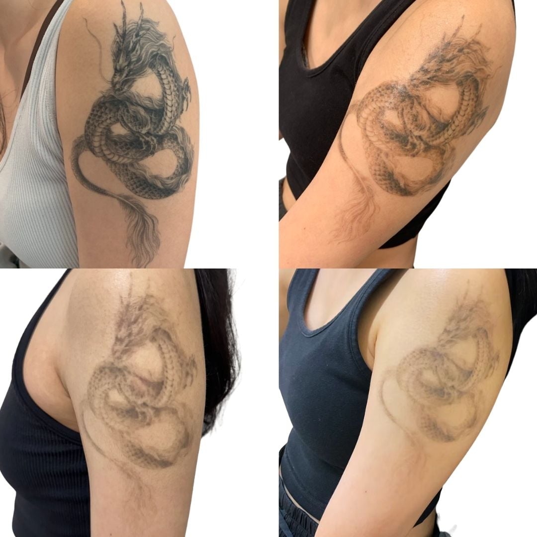 Tattoo Removal