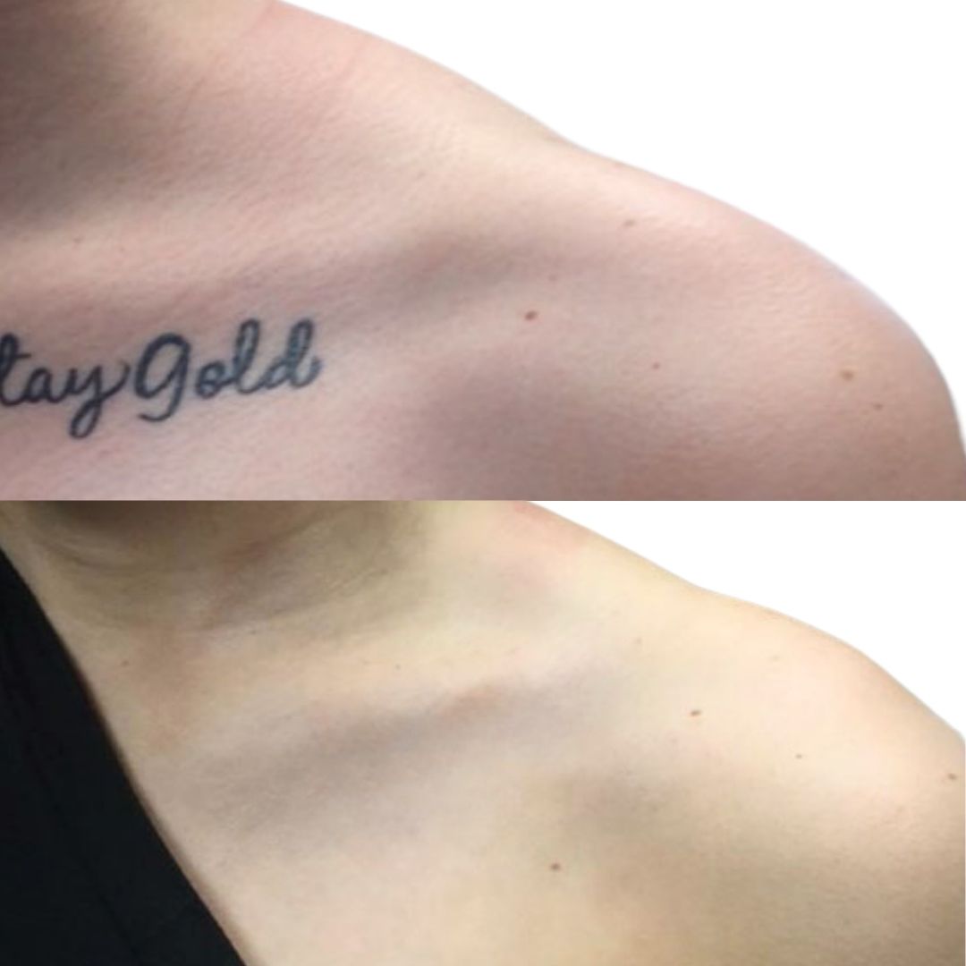 Tattoo Removal (2)