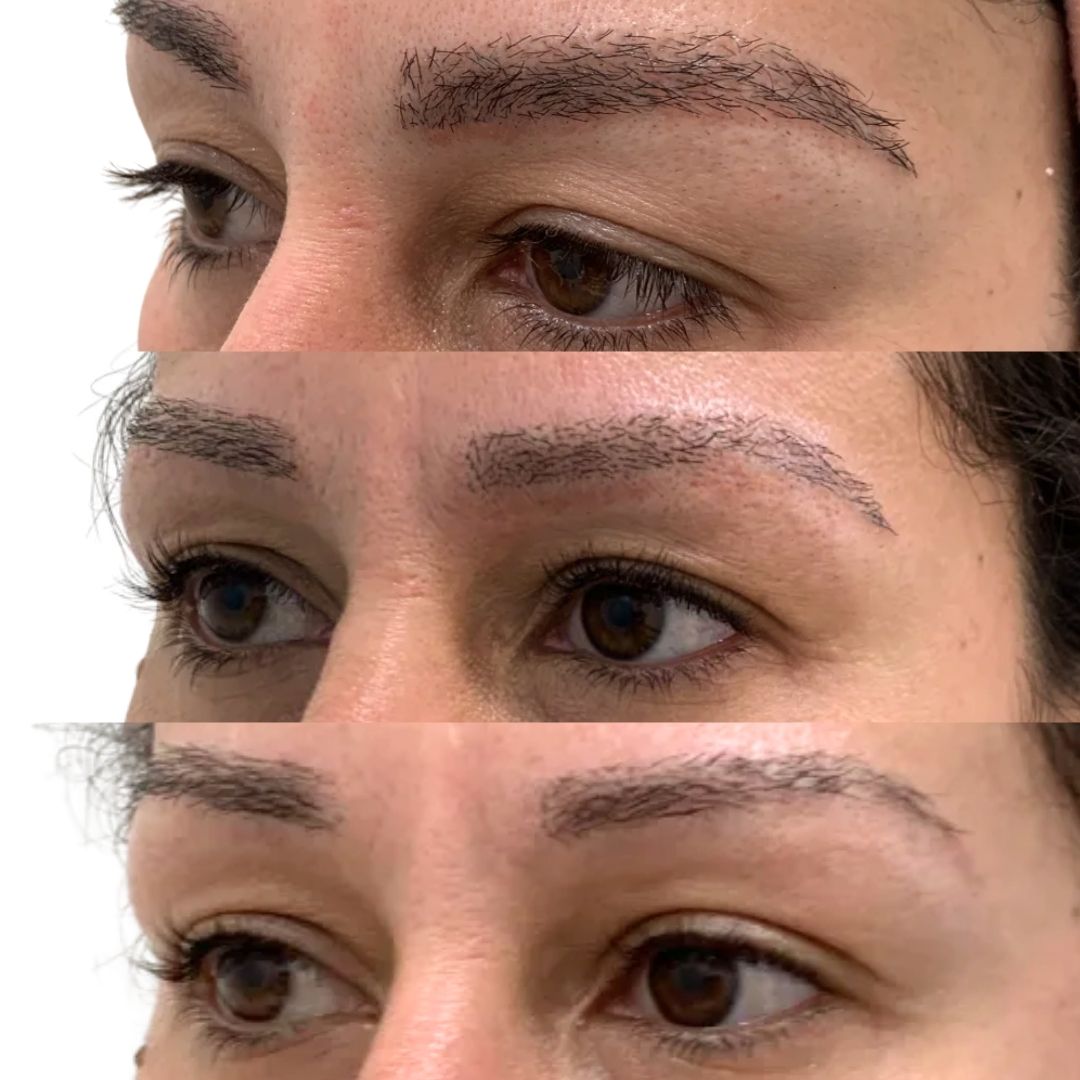 Tattoo Removal (4)