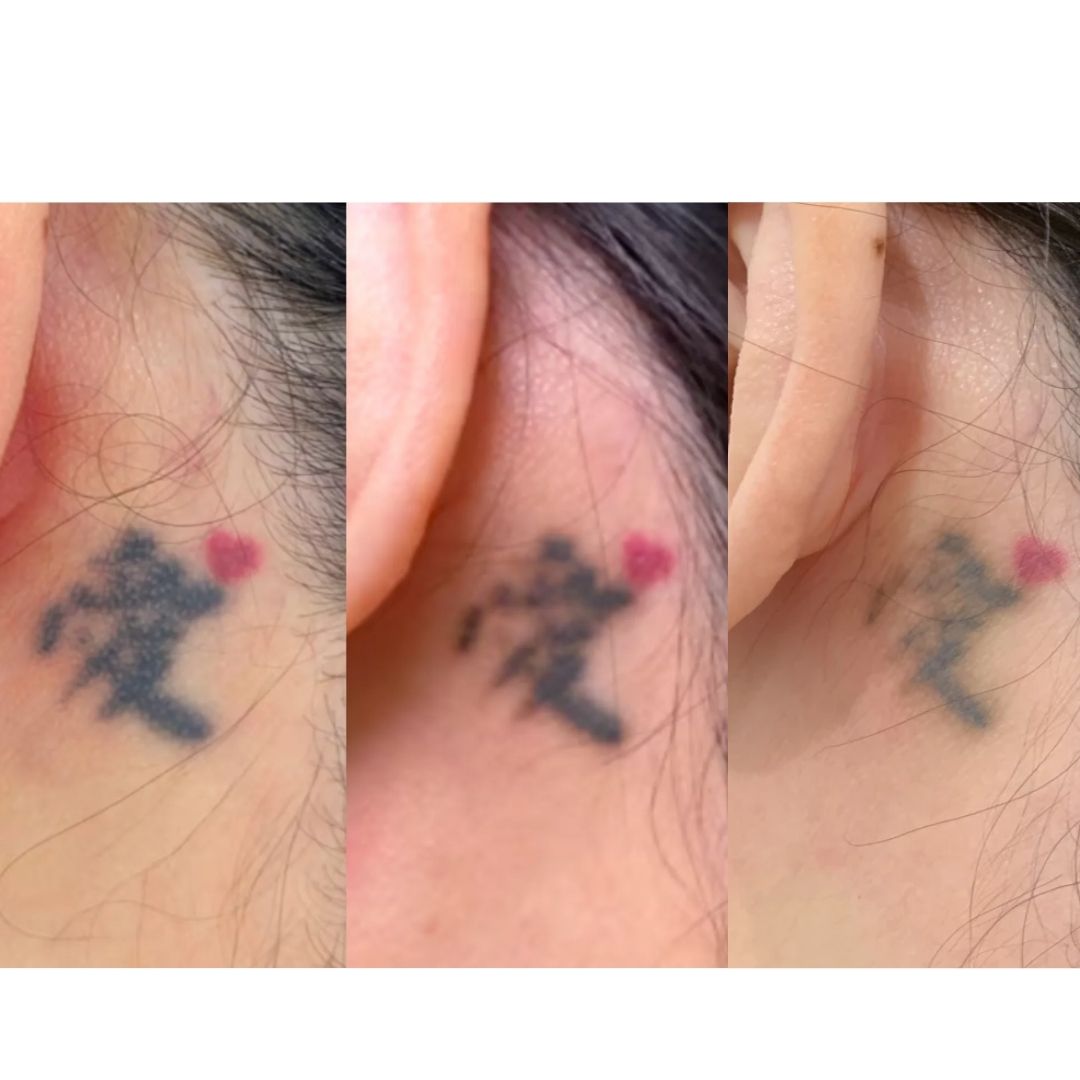 Tattoo Removal (5)