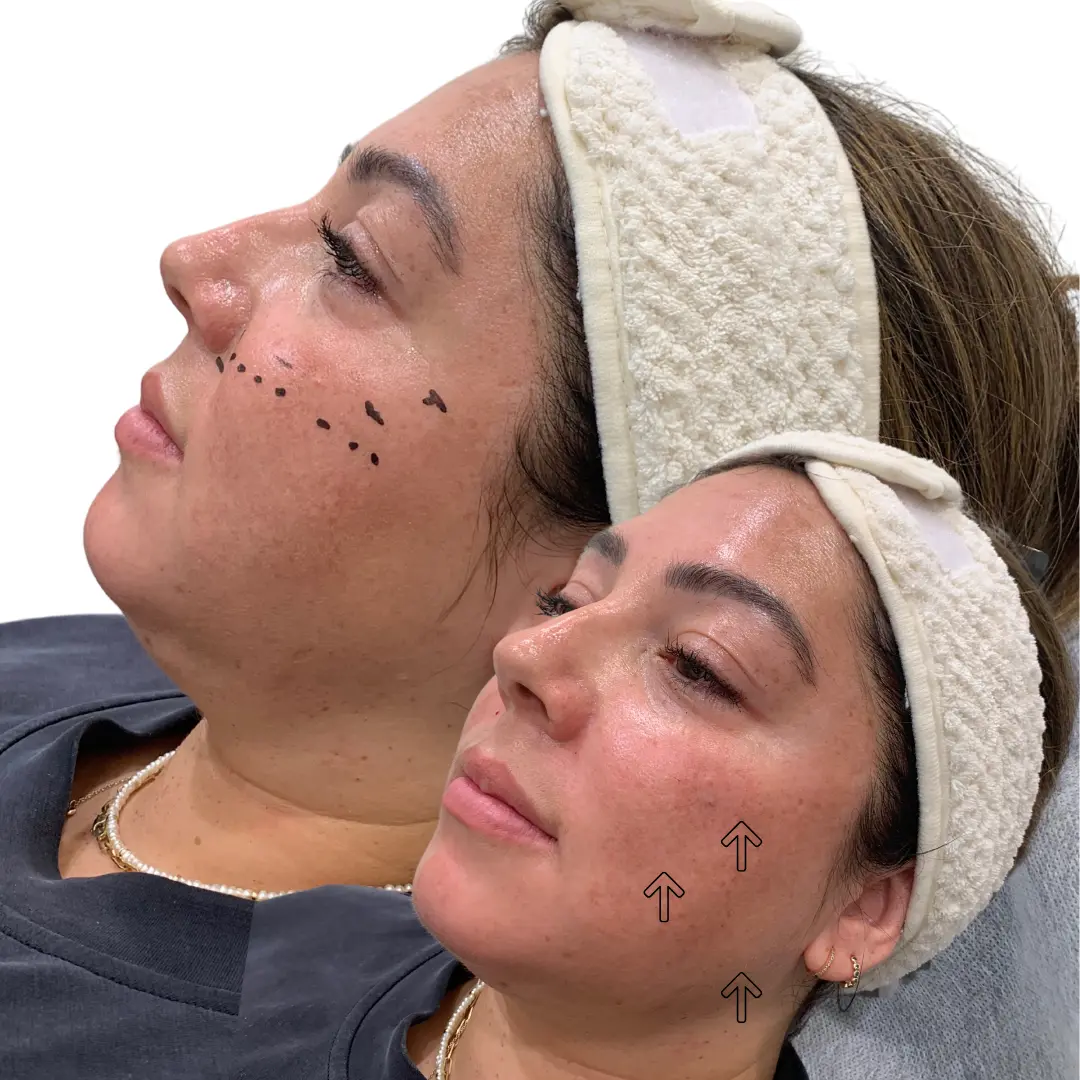Facial balancing before and after result at JT Aesthetic and Co