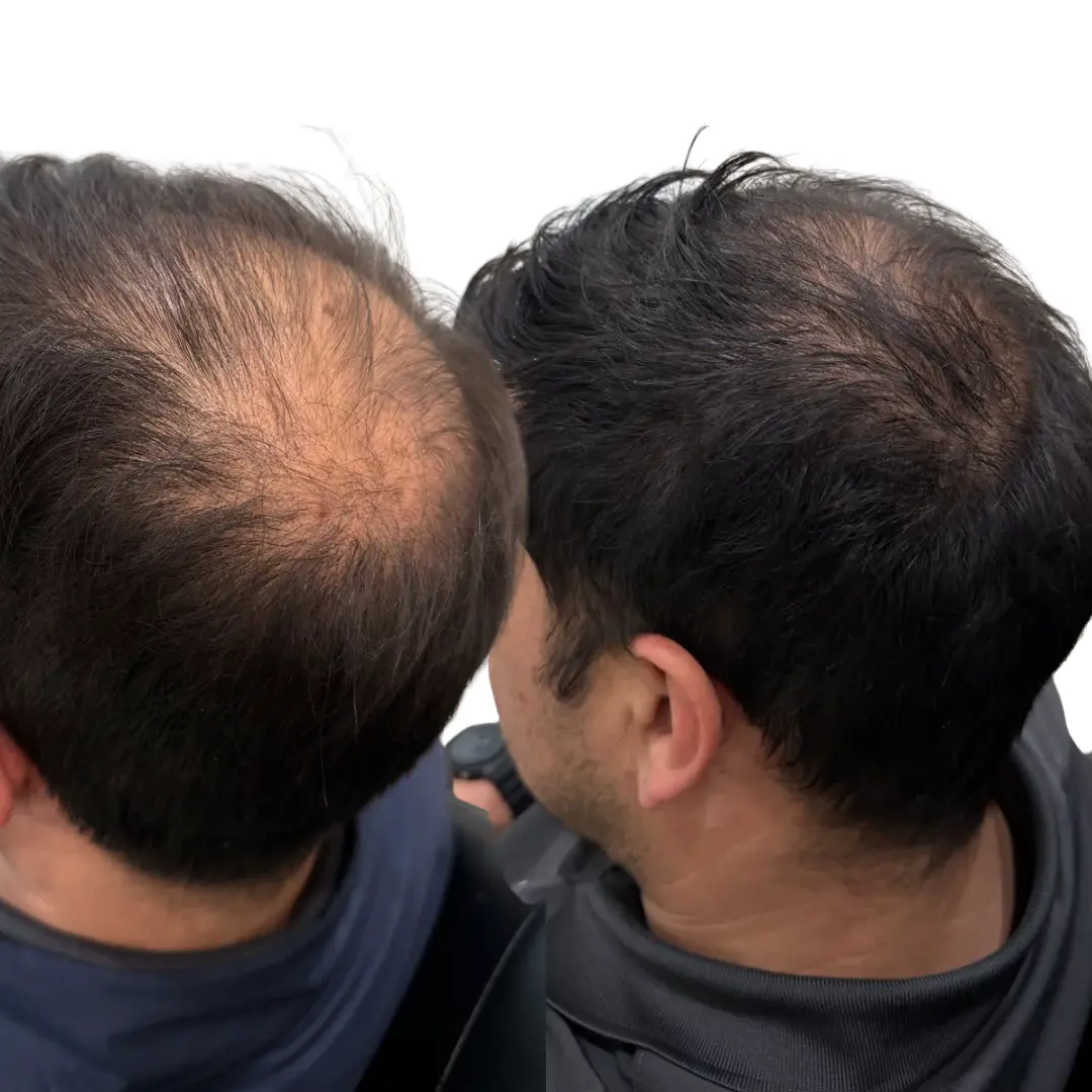 Hair restoration before and after result at JT Aesthetic and Co