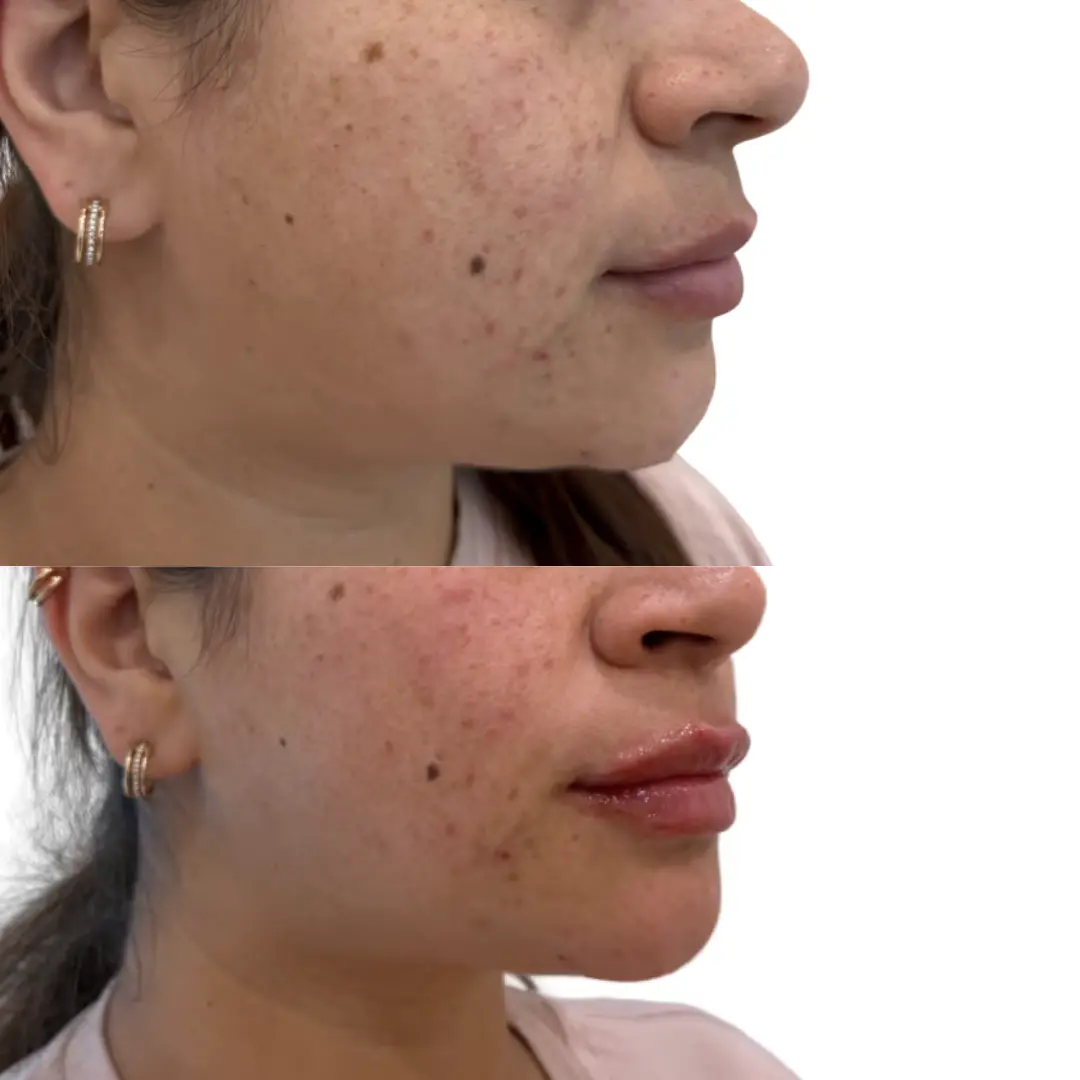 Lip filler before and after result 01 at JT Aesthetic & Co