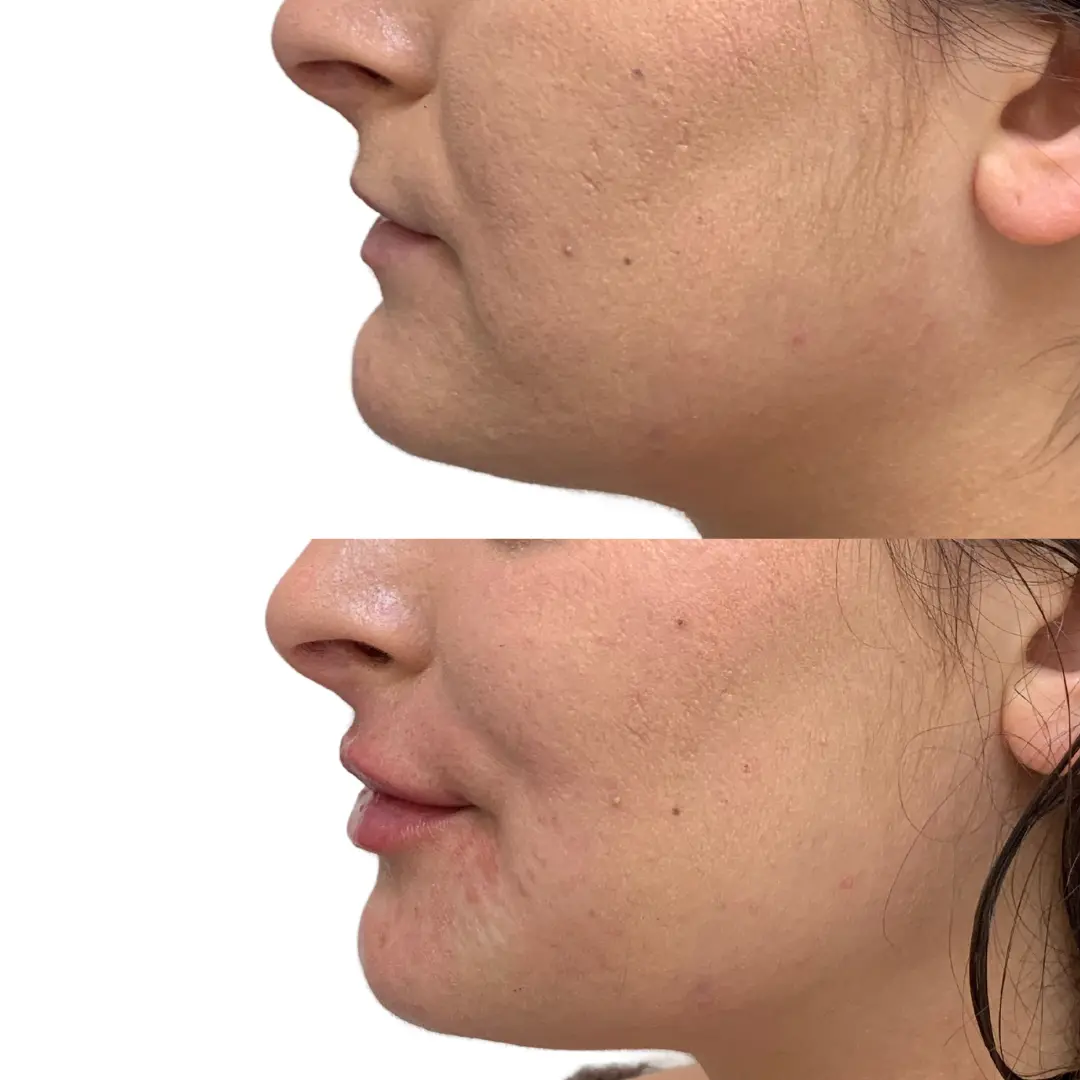Lip filler before and after result 03 at JT Aesthetic & Co