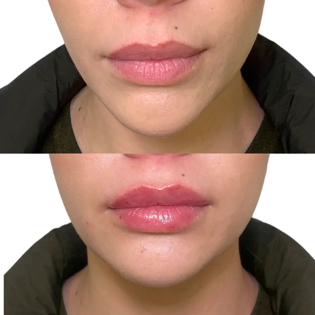 Lip filler before and after result at JT Aesthetic and Co