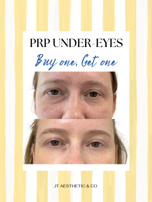 prp under-eyes